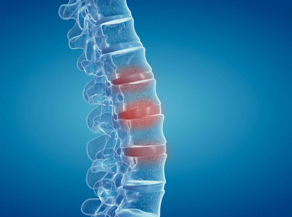 St. Louis Back Injury Lawyers. Spinal image.