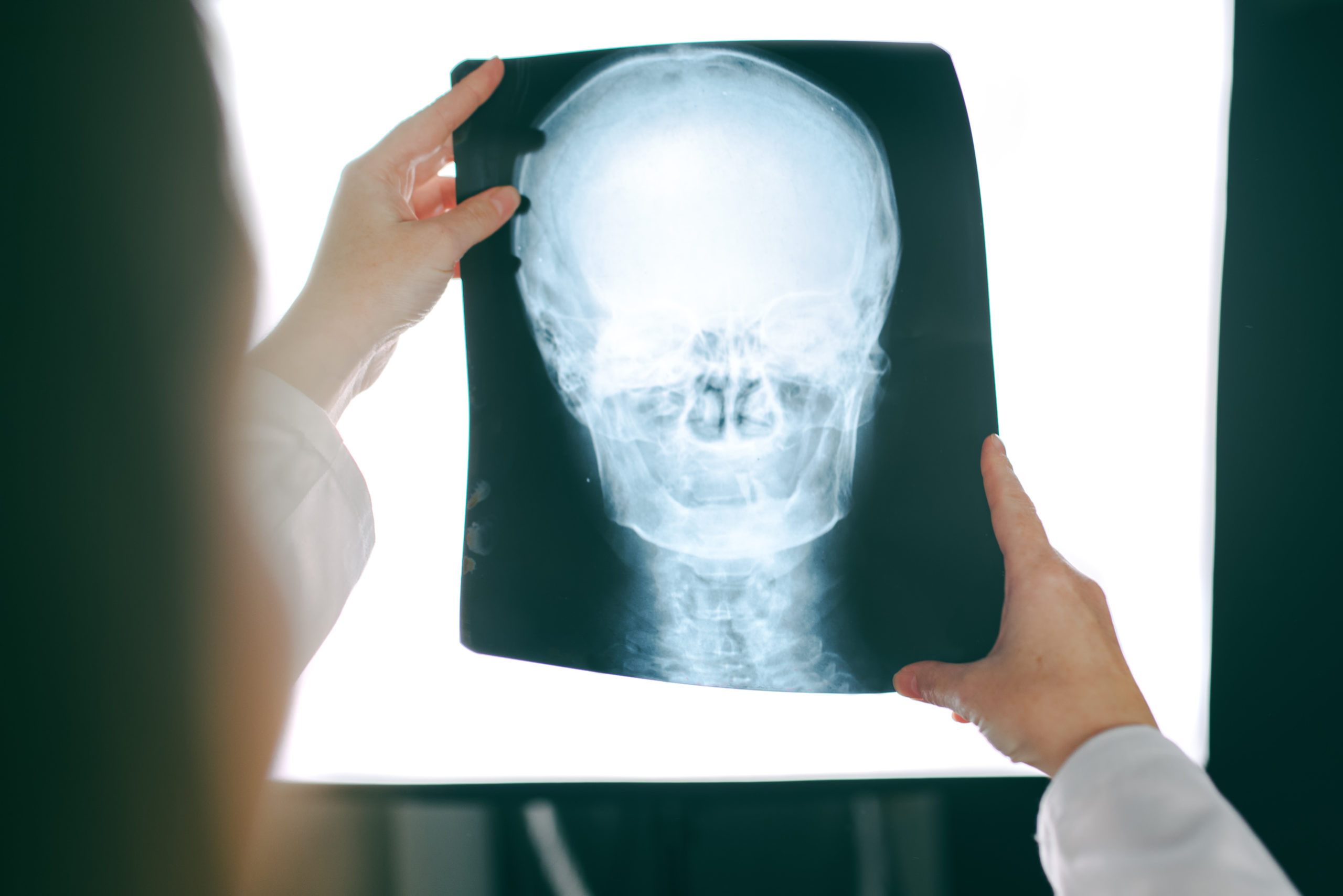 How To Value Your Head And Neck Injury After A Car Accident
