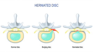 How To Value Your Head And Neck Injury | Cantor Injury Law Herniated Disc. How To Value Your Head And Neck Injury.